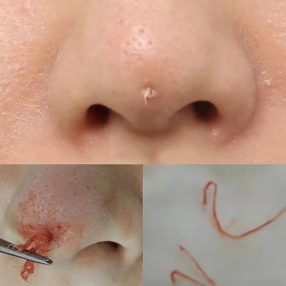 线雕隆鼻的3大危害!