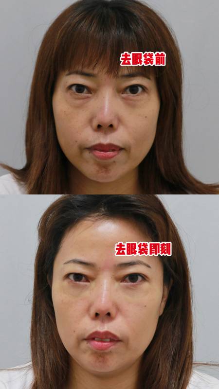 48岁女士,眼袋脂肪膨出非常严重,刚做完微创去眼袋即刻,效果非常明显!