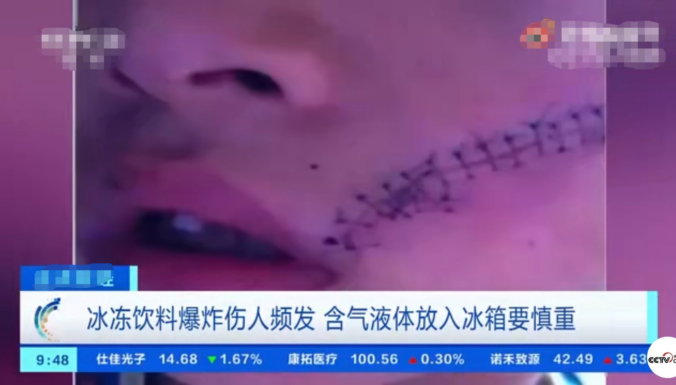 男孩开冰可乐被炸伤缝38针#】  近日,上海嘉定一男孩从冰箱拿出夜罐