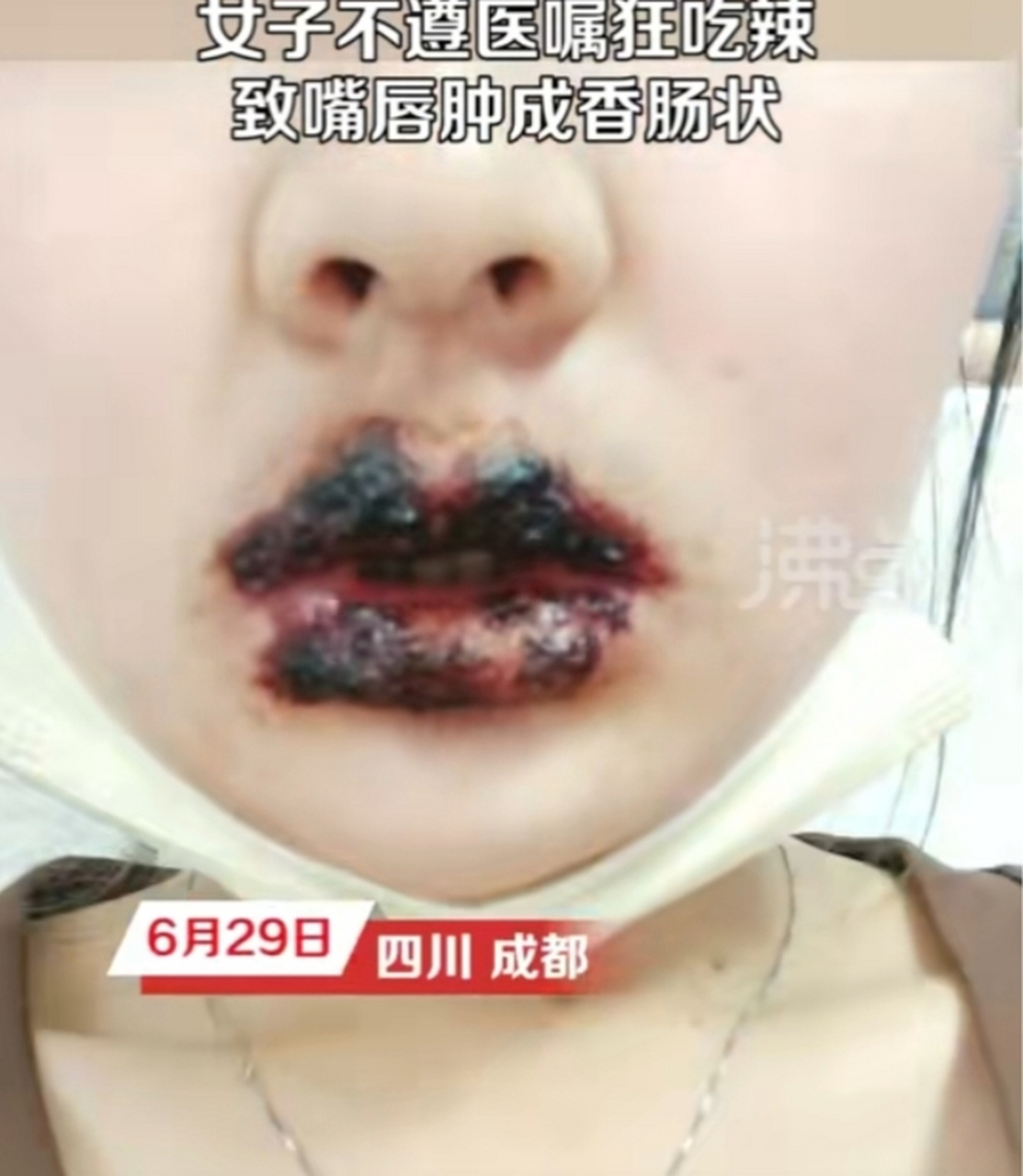 一名女子因早期嘴巴过敏就医后,却不遵医嘱狂吃辛辣食物,导致嘴唇肿胀