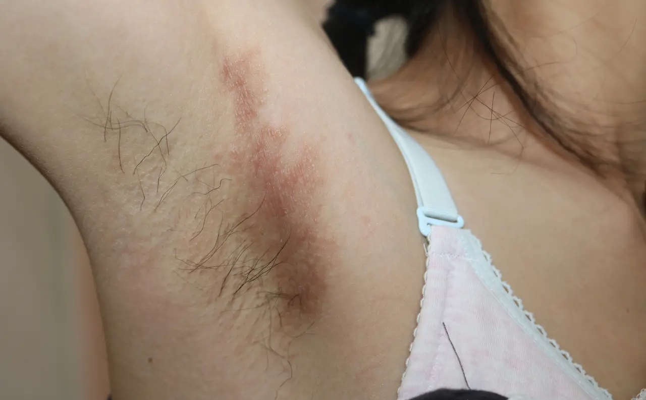 艘赶抡 菌感染图片腋窝湿疹的6种图片腋窝真菌感染症状图片腋毛癣图片