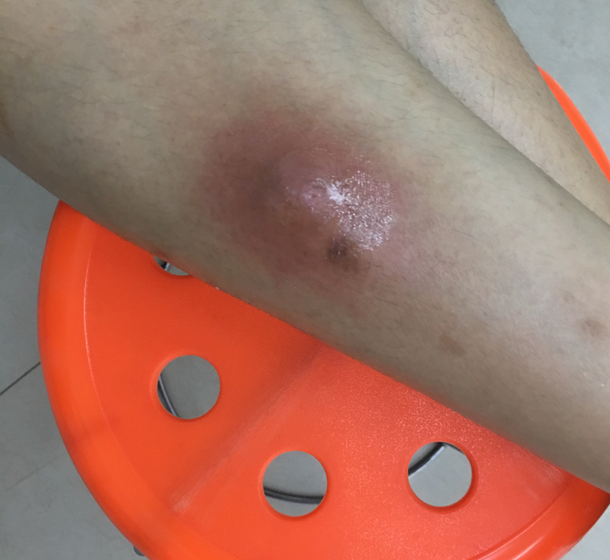不知道被什么虫子咬了,千万不要用手抓
