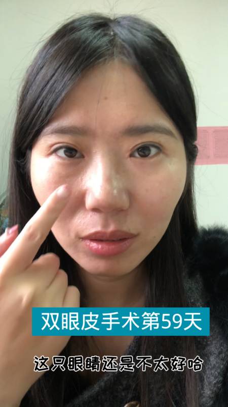 双眼皮手术第59天了,眼睛还是不对称,失败了-度小视