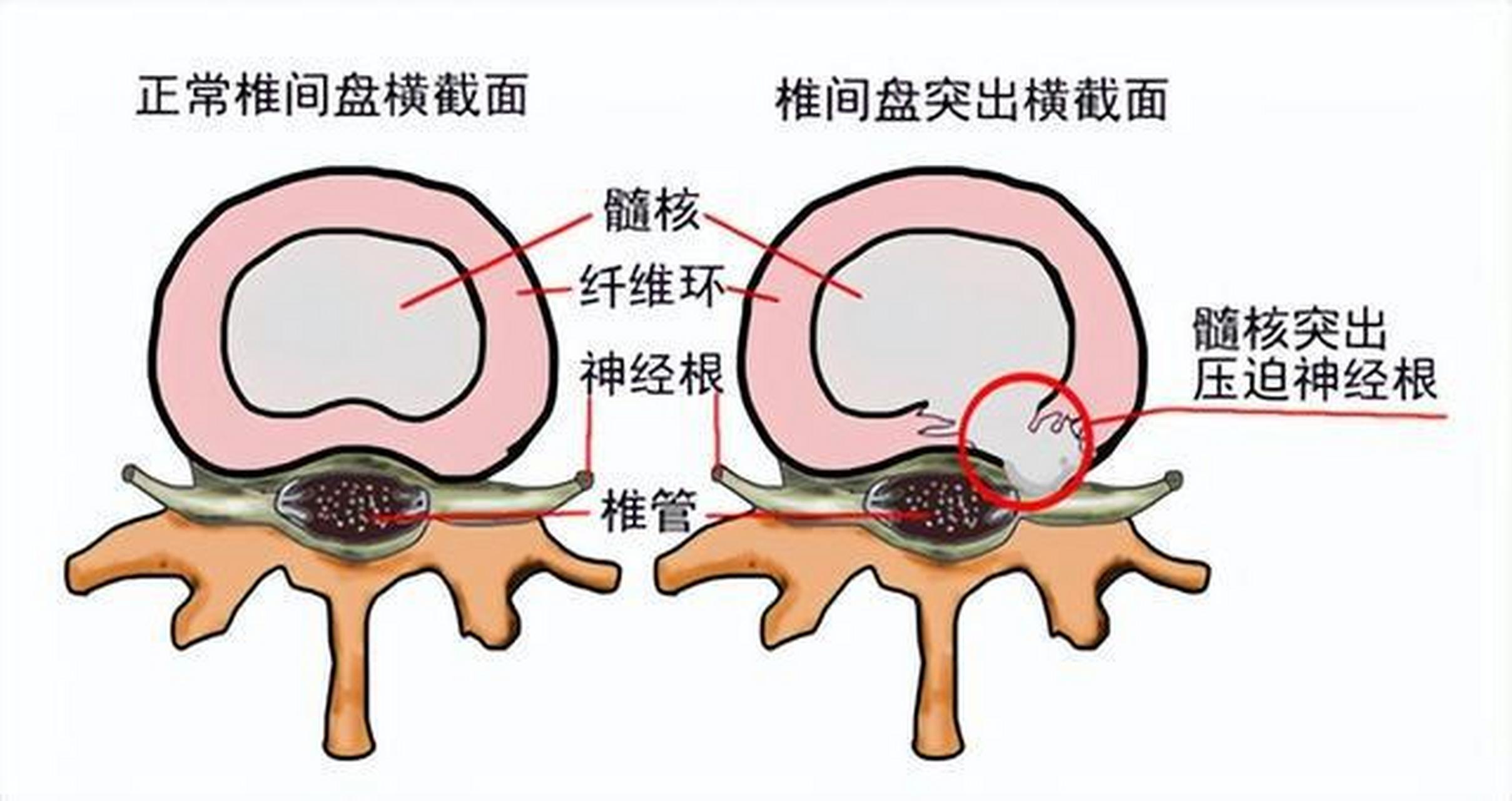 如果出现椎间盘突出首先是由于髓核的疝出,带来了相应的肢体