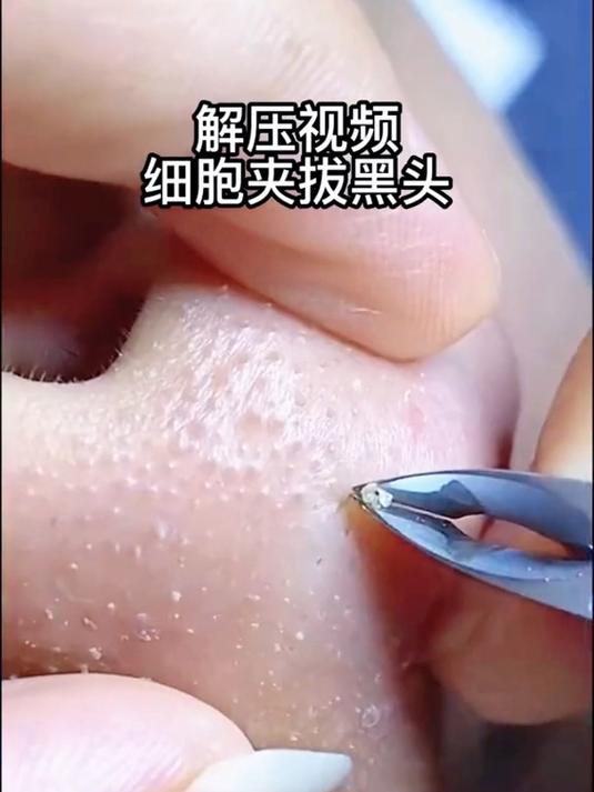 针挑黑头4328图片