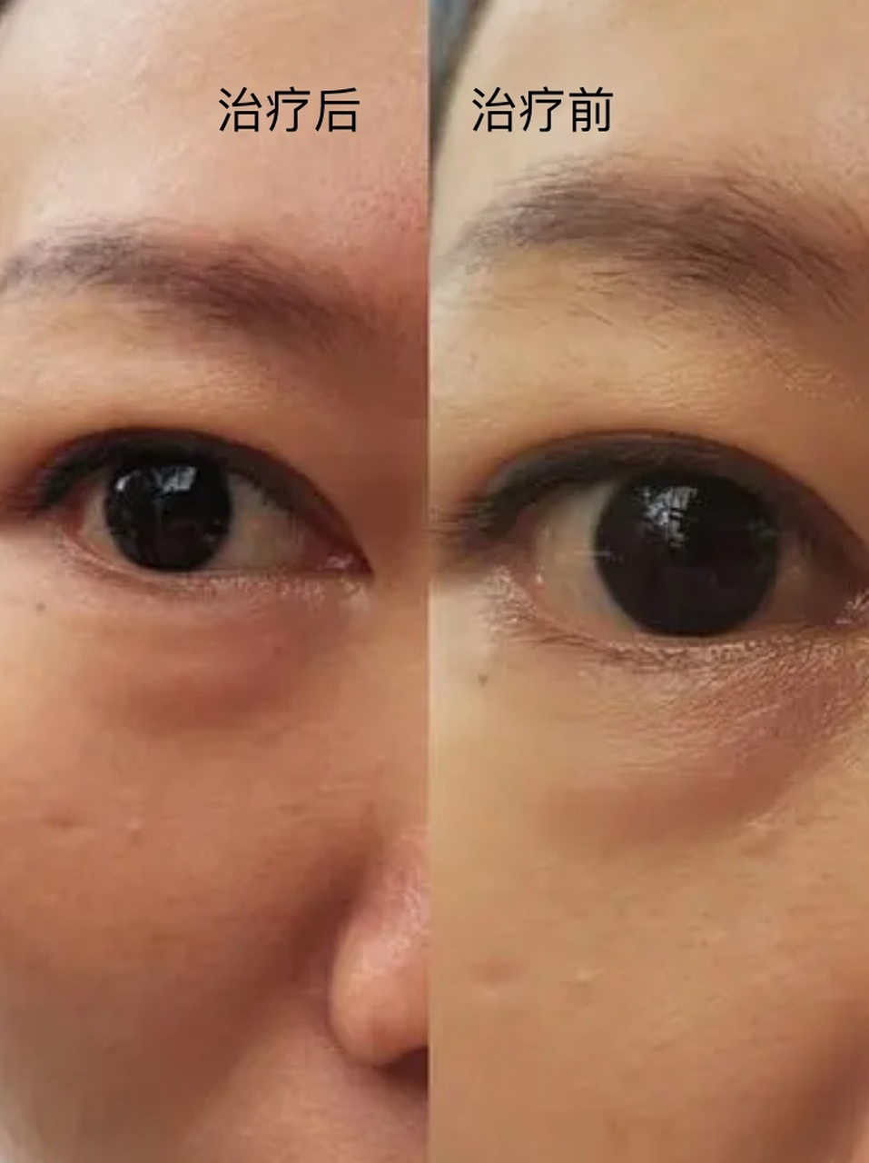 去眼袋手术多少钱啊 #眼袋修复#  去眼袋手术一般需要3000元到8000元