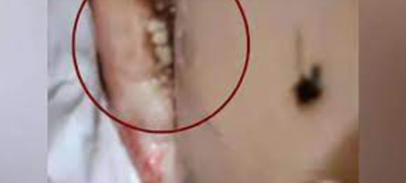 网红小敏甲状腺癌身体长蛆原视频图片 小敏来了抗癌背后大洞长虫子图片