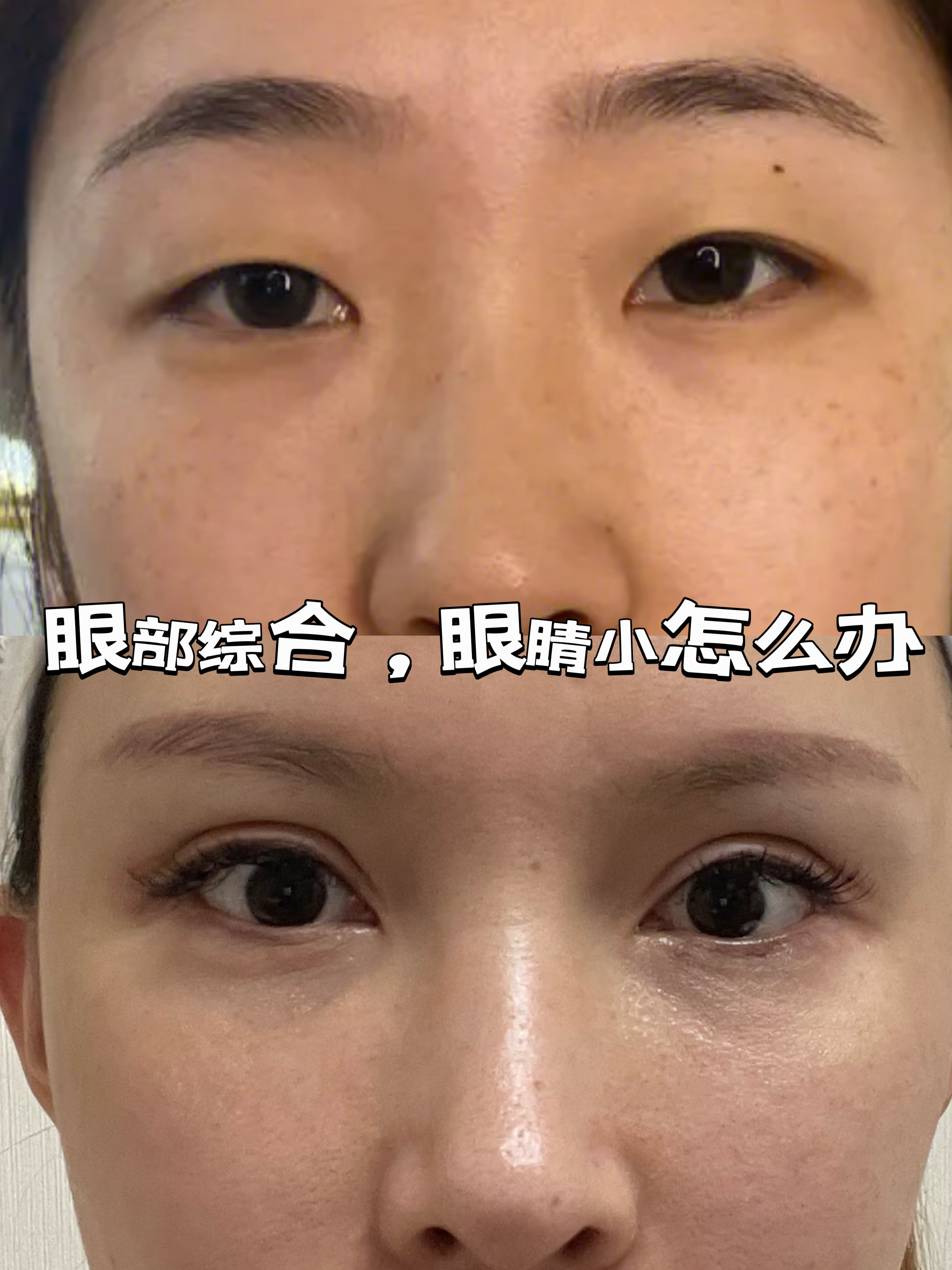 术前情况 我就是天生眼睛比较小,看起来在整个脸上的占比比较小,所以