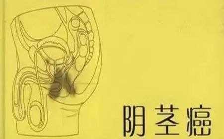 长期炎症诱发阴茎癌,阴茎部分切除术后顺利痊愈