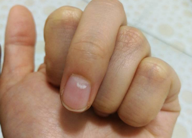 体内有病,"手指"先知?提醒:若出现5种迹象,早做癌筛查
