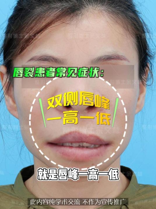 双侧唇峰一高一低?