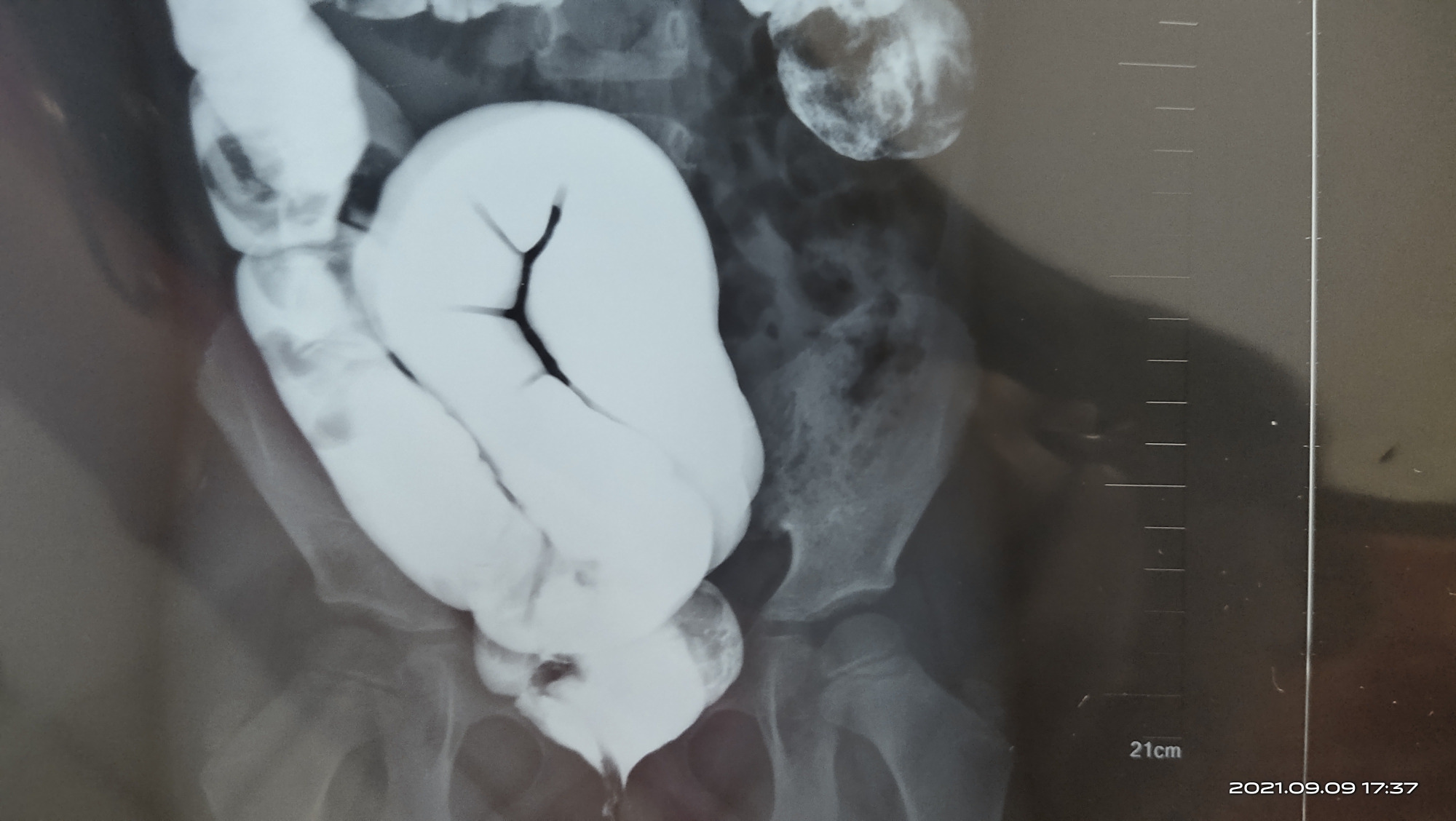 小小便秘不注意,拖成乙状结肠迂曲冗长,宝宝家长后悔不已