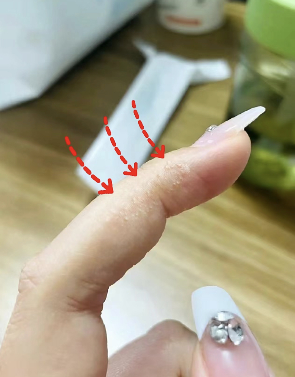 湿气重了, 手上会有这3种变化, 第2种简直让人烦死:  1,手心总是