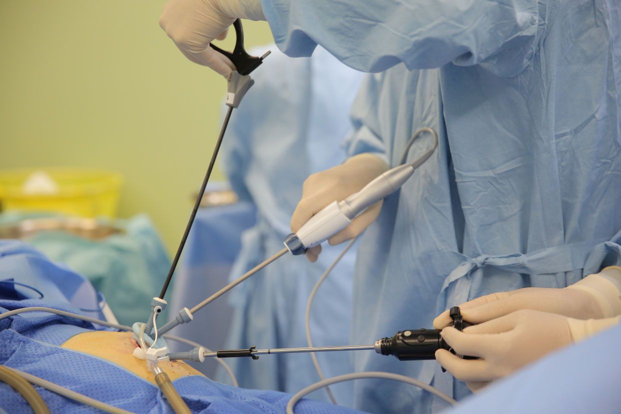 单孔腹腔镜在直肠癌手术的应用