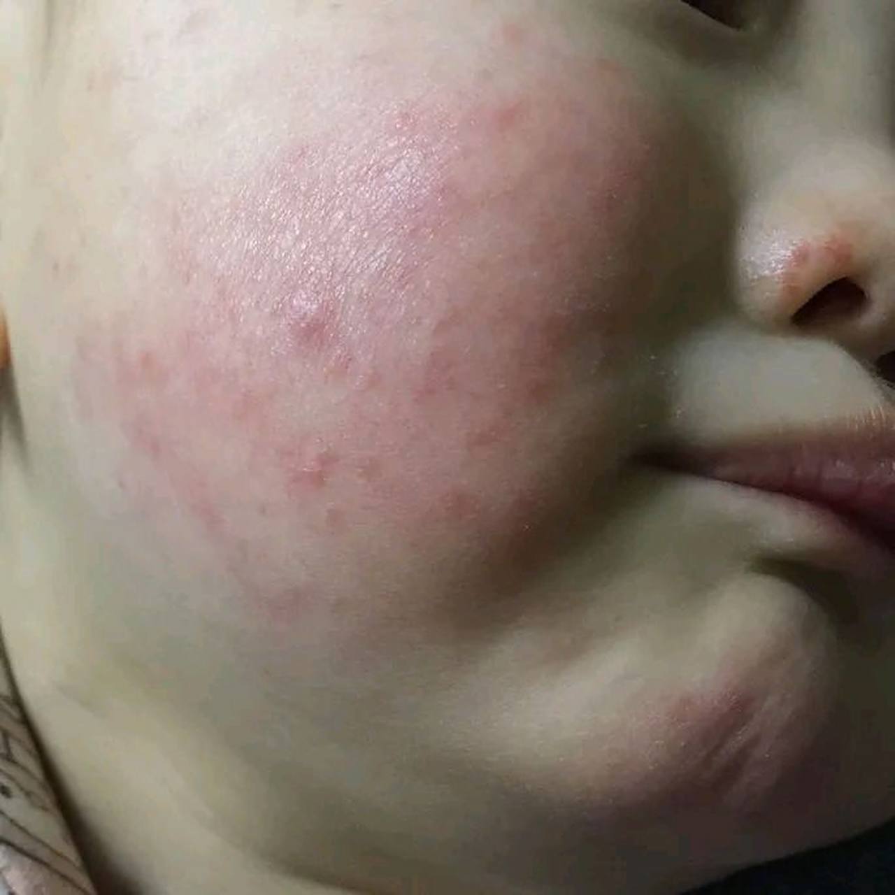 孩子脸上有湿疹,可以用弱效激素药膏吗?会不会有副作用?