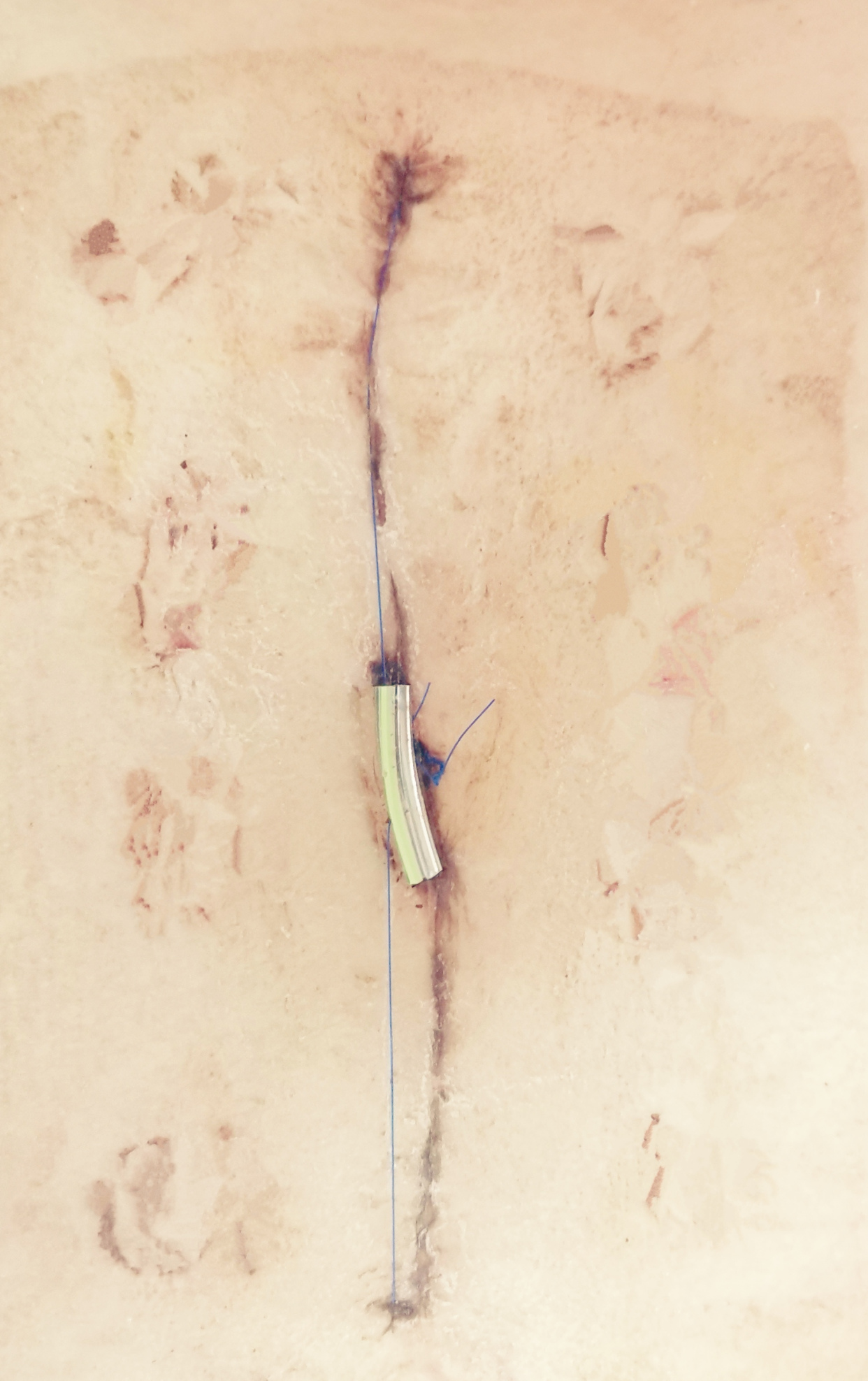 心脏术后伤口感染改良清创美容缝合手术