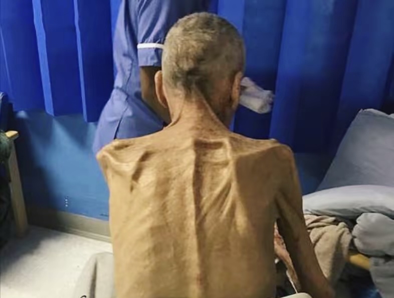 濮阳县医院,冯清林瘫在病床上,瘪成了皮包骨