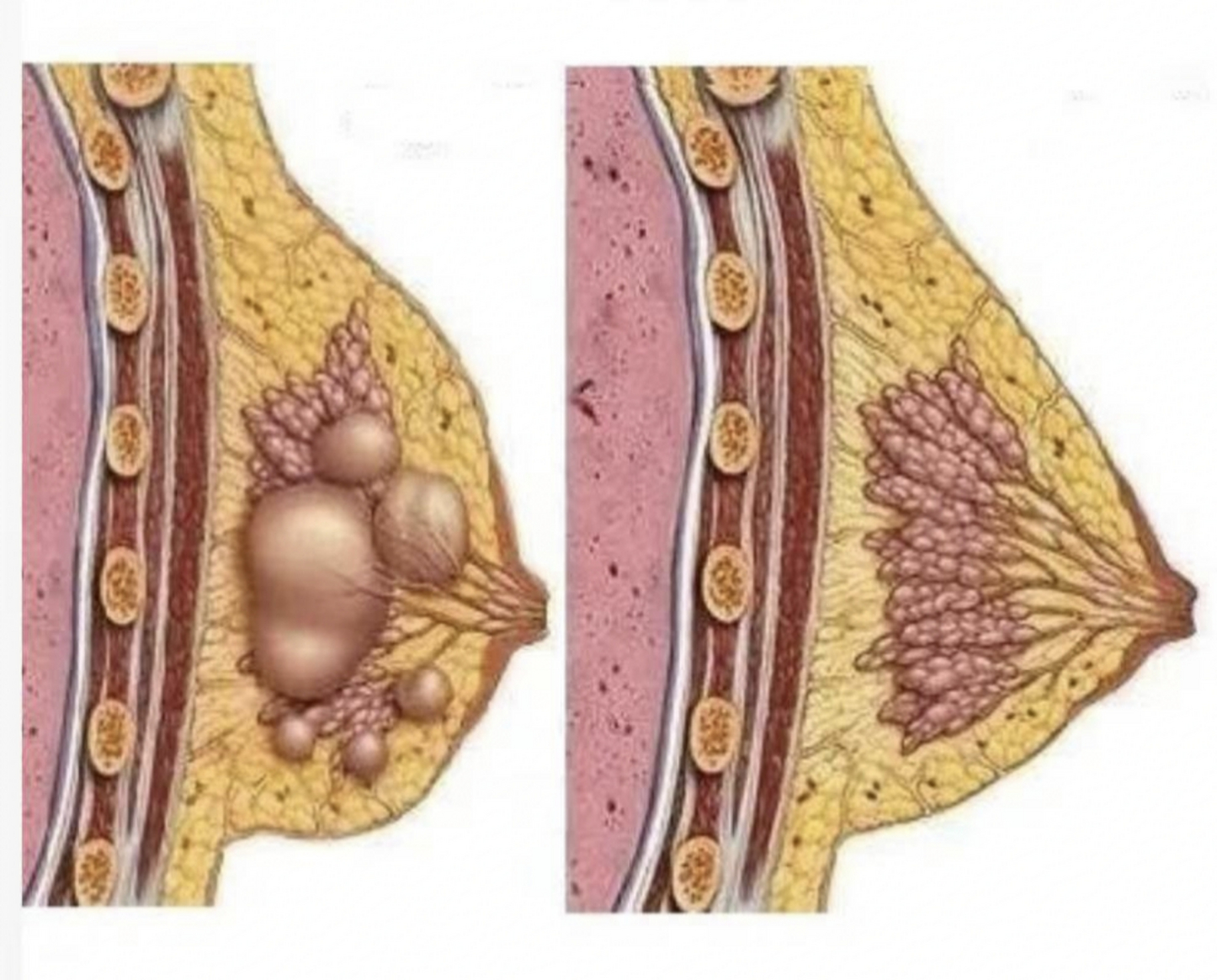 乳腺癌早期肿块图片图图片