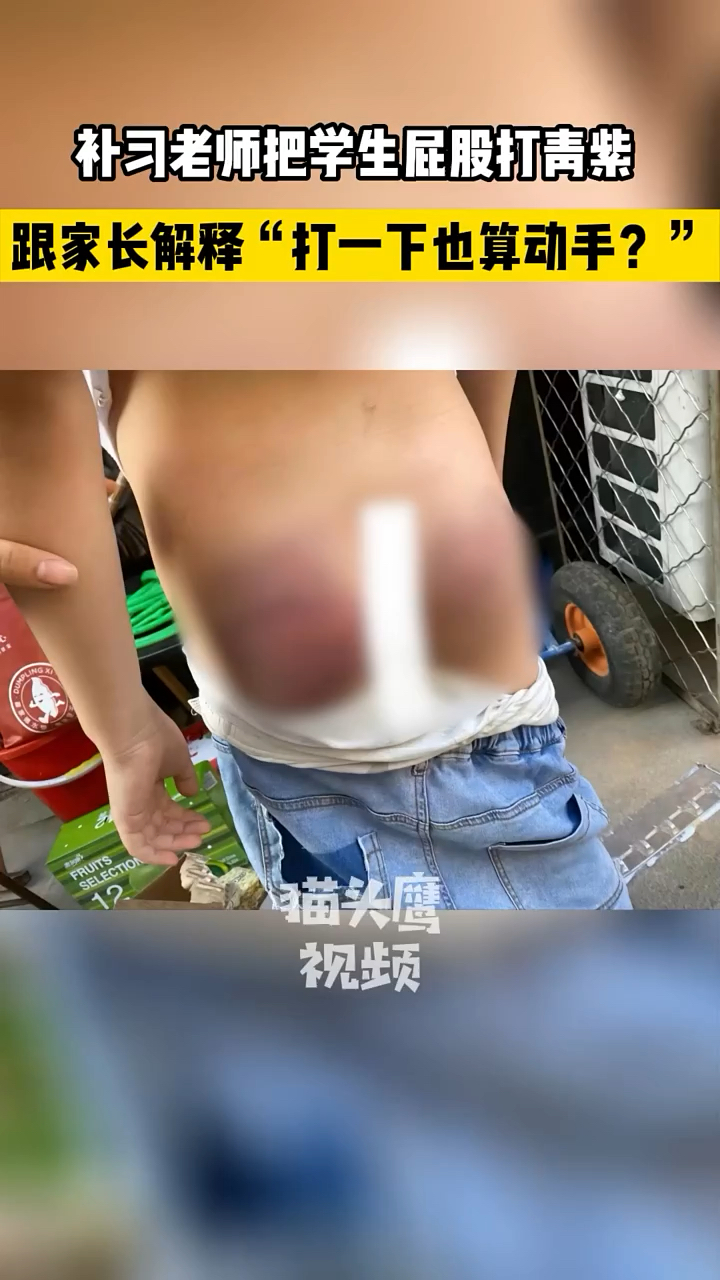 7月28日黑龙江牡丹江10岁孩子上补习班屁股手臂被老师打得青紫网易