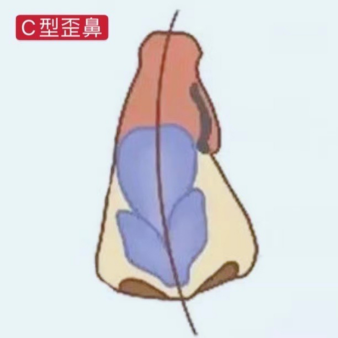 隆鼻术后c形歪鼻修复矫正  99肋软骨抬高鼻梁,一定会发生弯曲变形吗