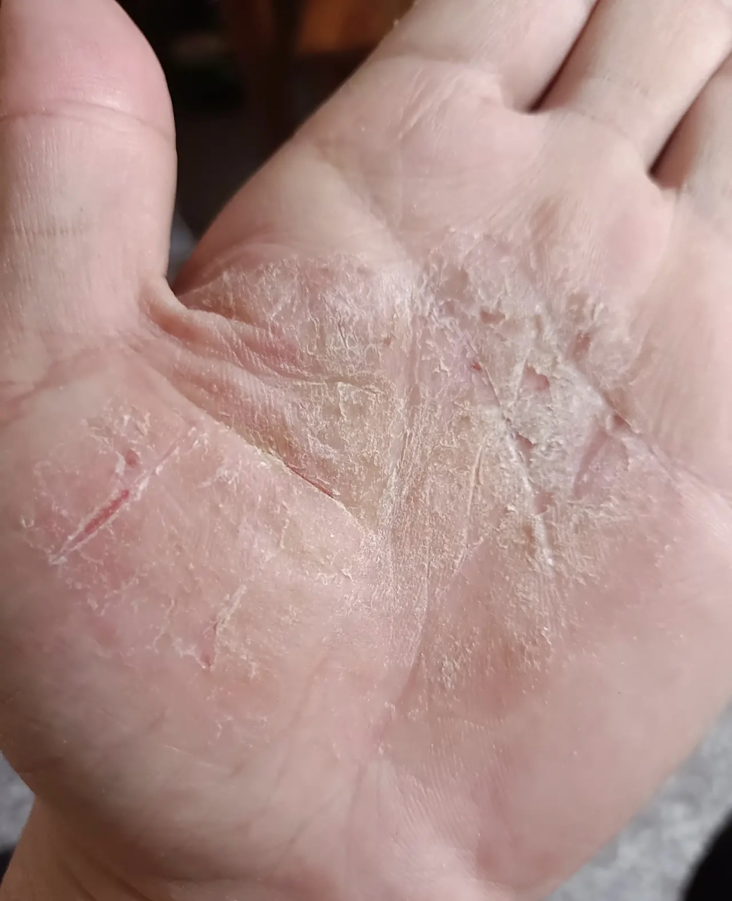 强大的网友们,手心长这个东西看了不少医生了,一年多了,太痛苦了,痒的