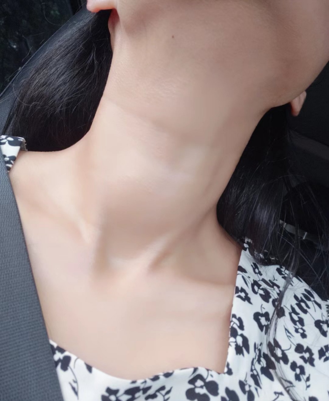 成功摆脱了甲亢脖粗困扰!