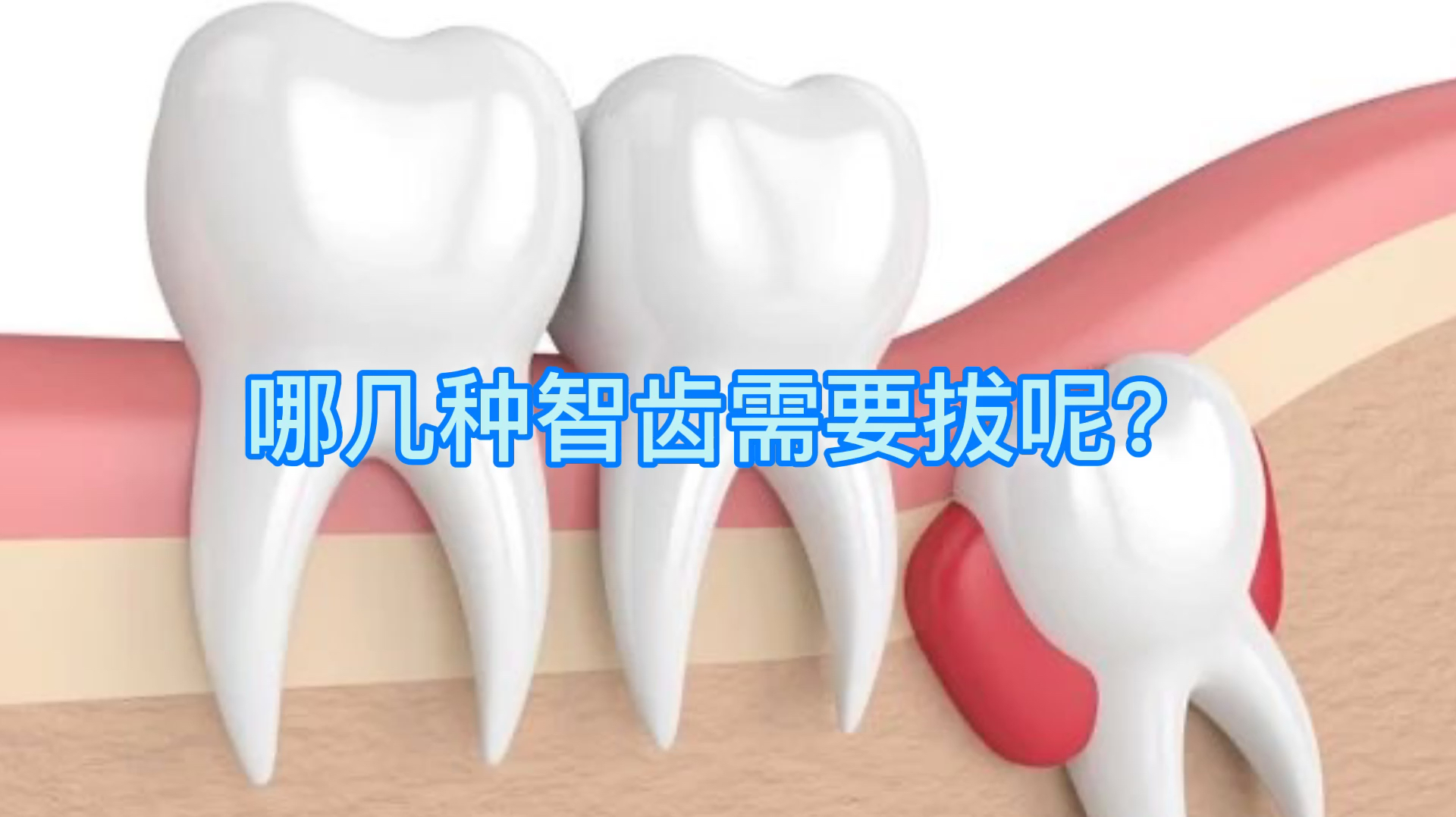所有的智齿都需要拔吗?哪几类智齿是一定要拔呢?