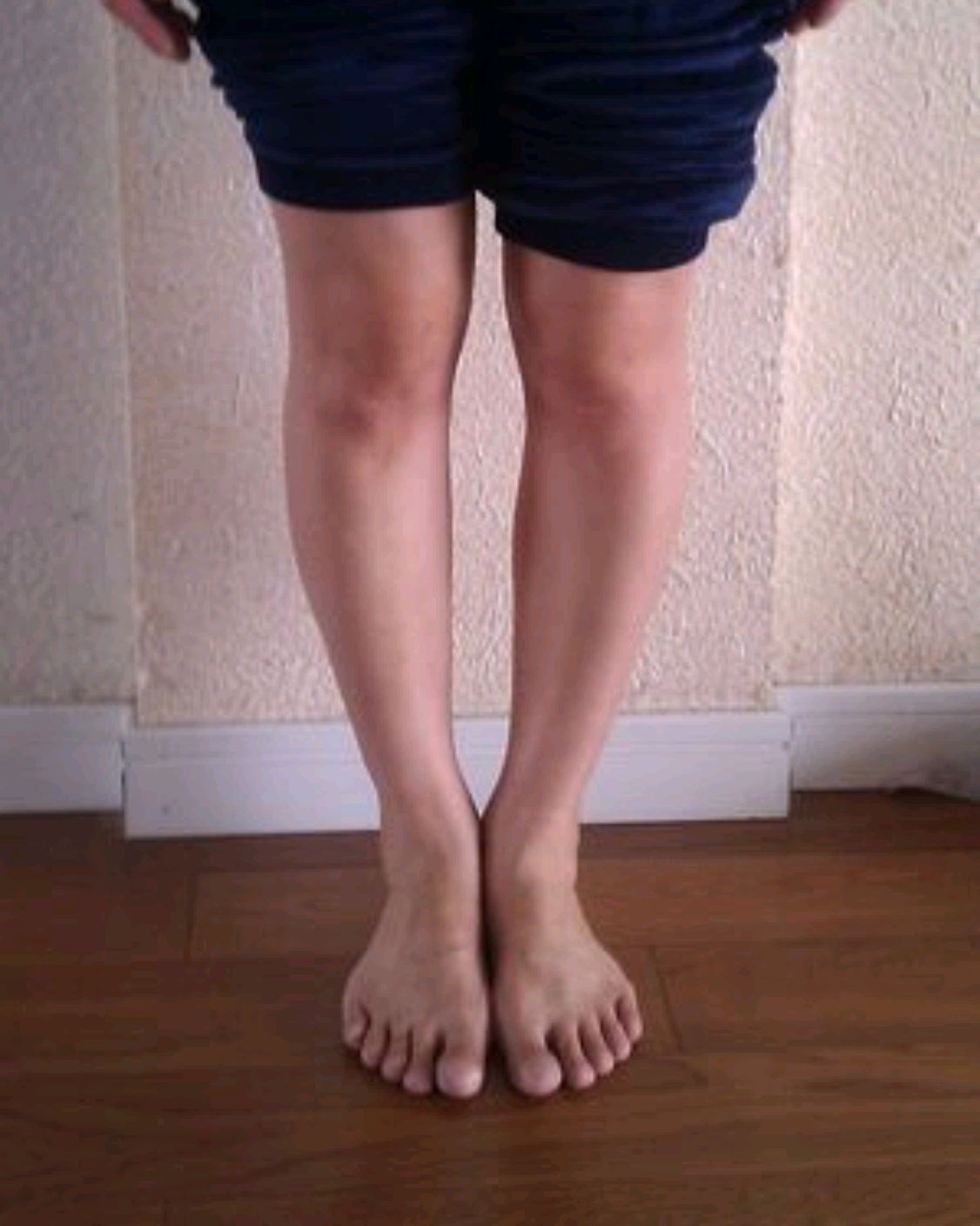 为什么我的腿型是歪的,那么难看?医生说,要考虑有没有拇外翻了