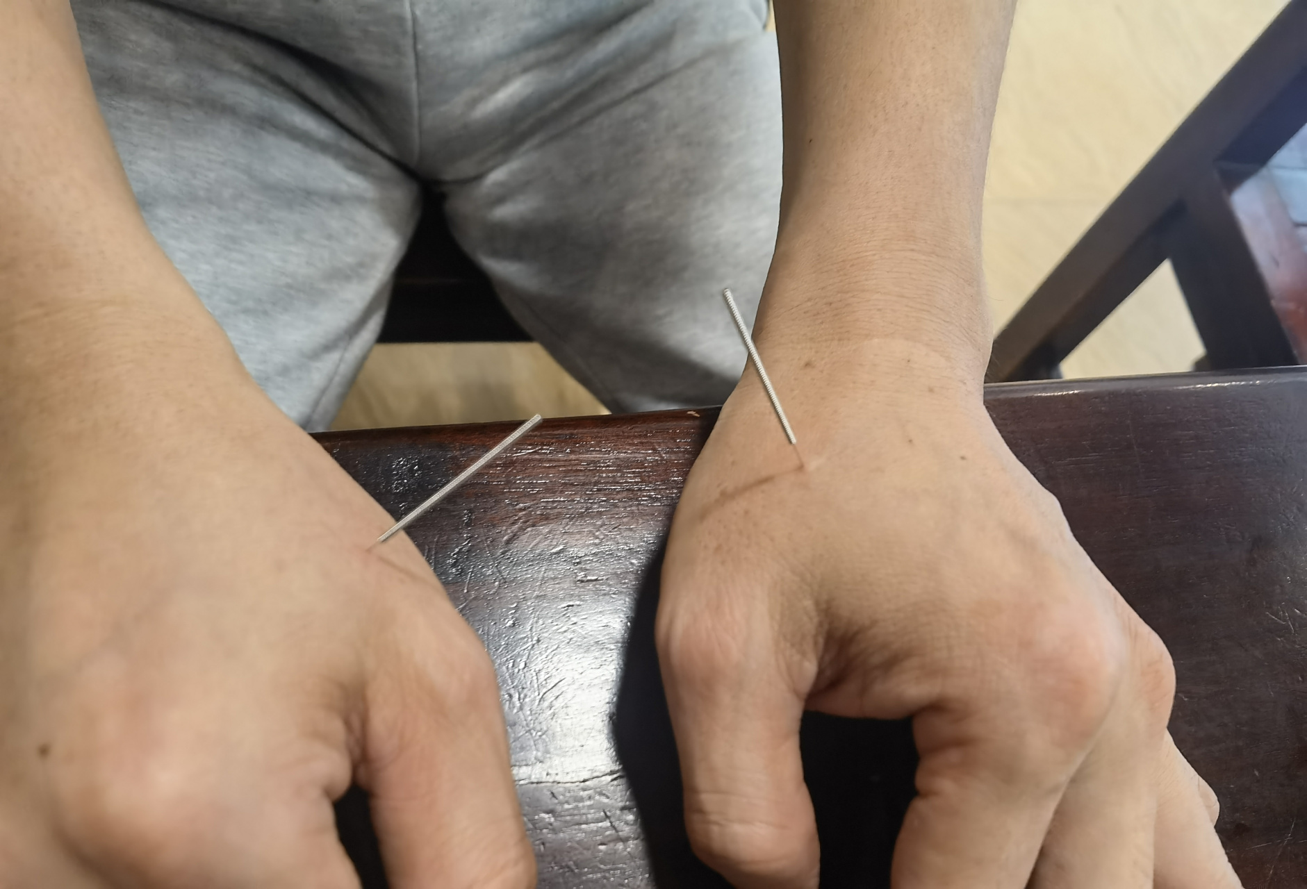 中医,博大精深,今天去被扎针,坚持一个疗程,应该会更好#中医# #针灸