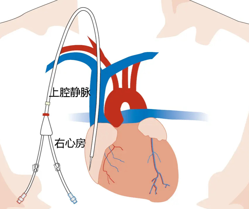临时管可以透析不