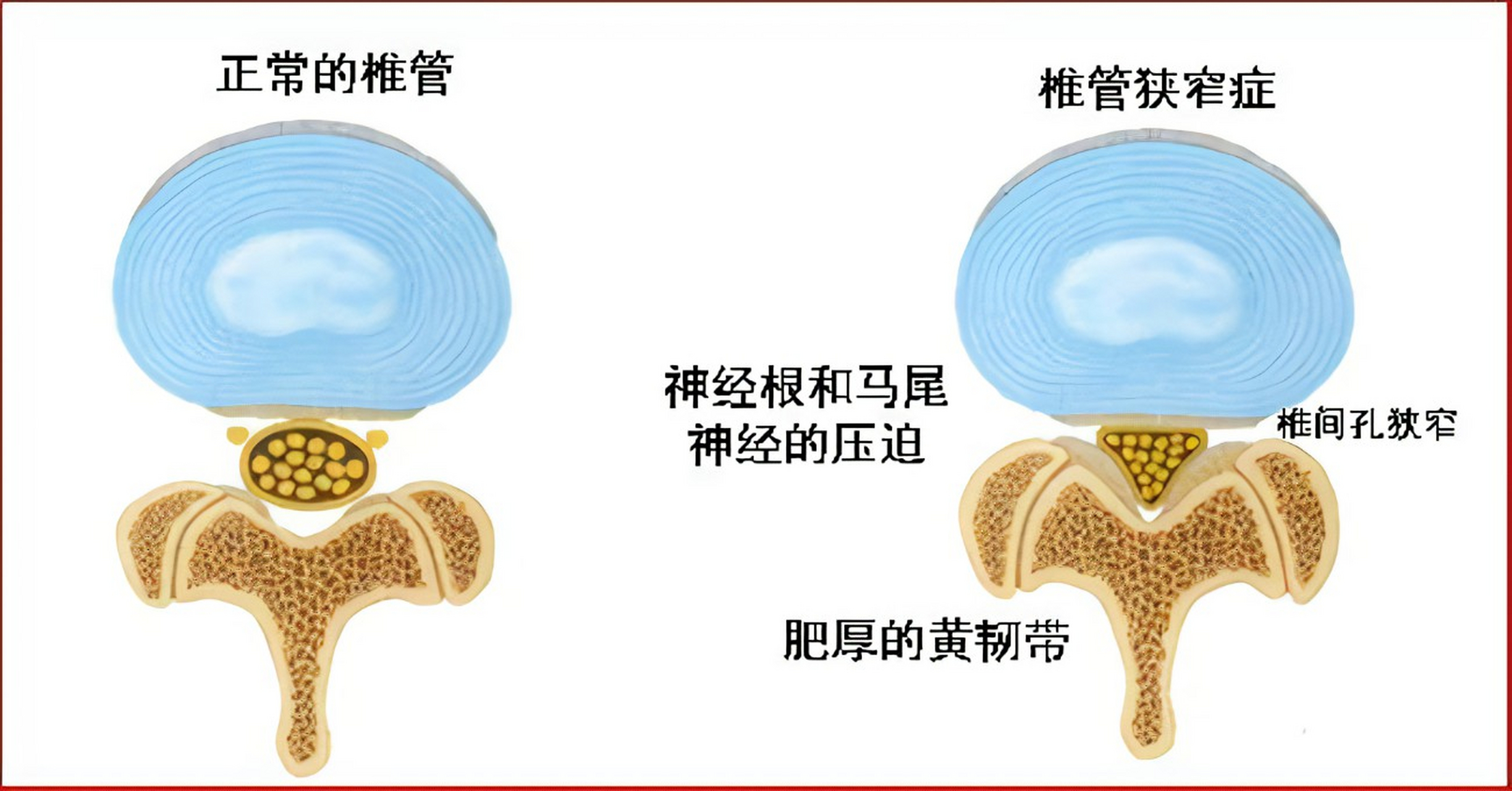 腰椎管狭窄该如何治疗?