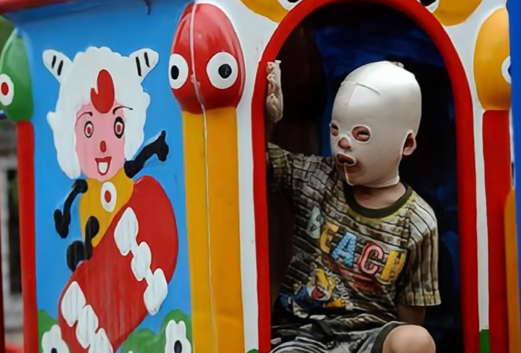 回顾山西"面具娃娃":遭大火烧伤心理扭曲,被小朋友排挤,后怎样