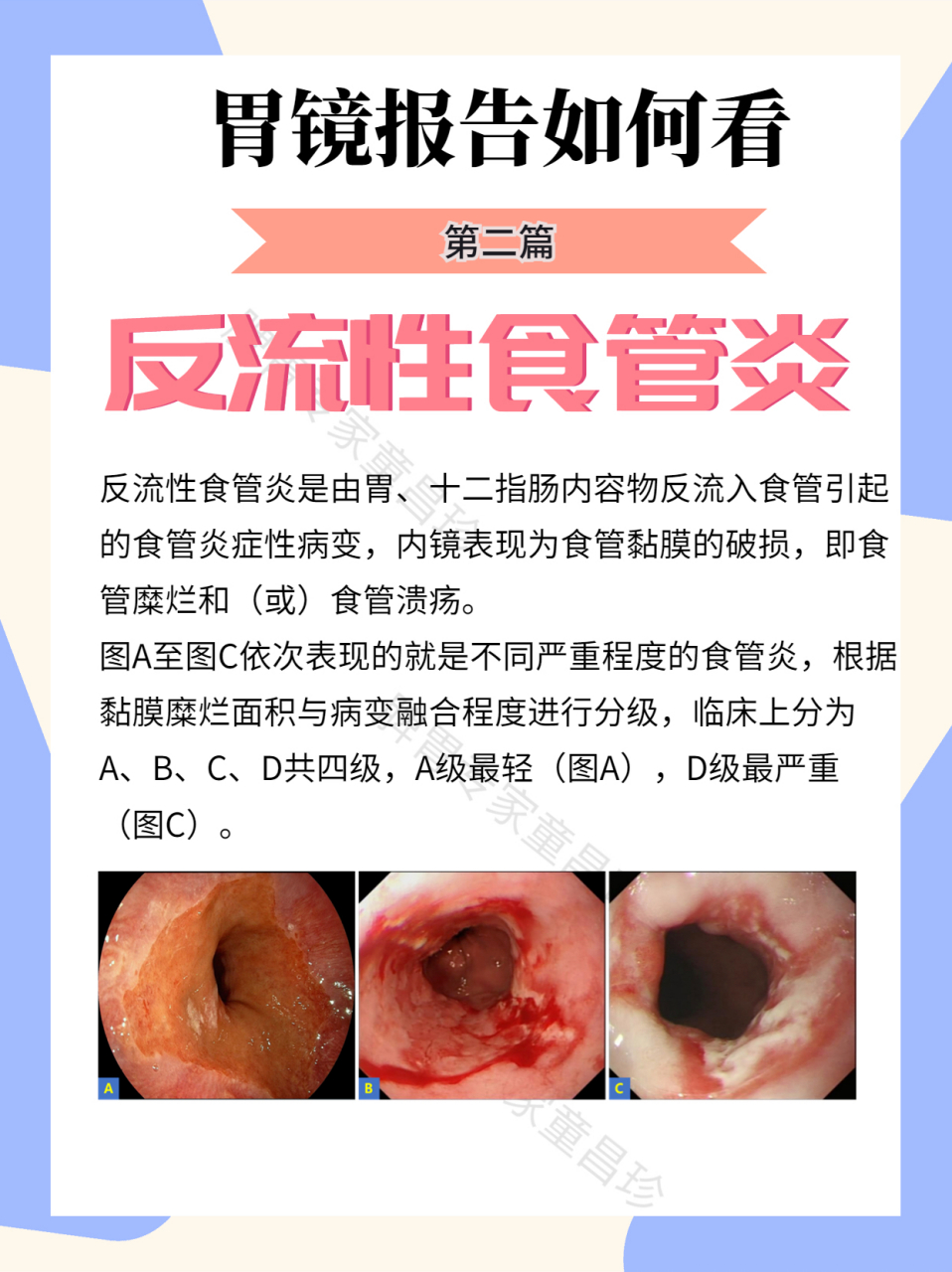 太难受了有一种生不如死叫反流性食管炎!