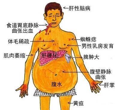 失代償期肝硬化病人同時存在著大量的能量消耗,同時還存在著營養不良