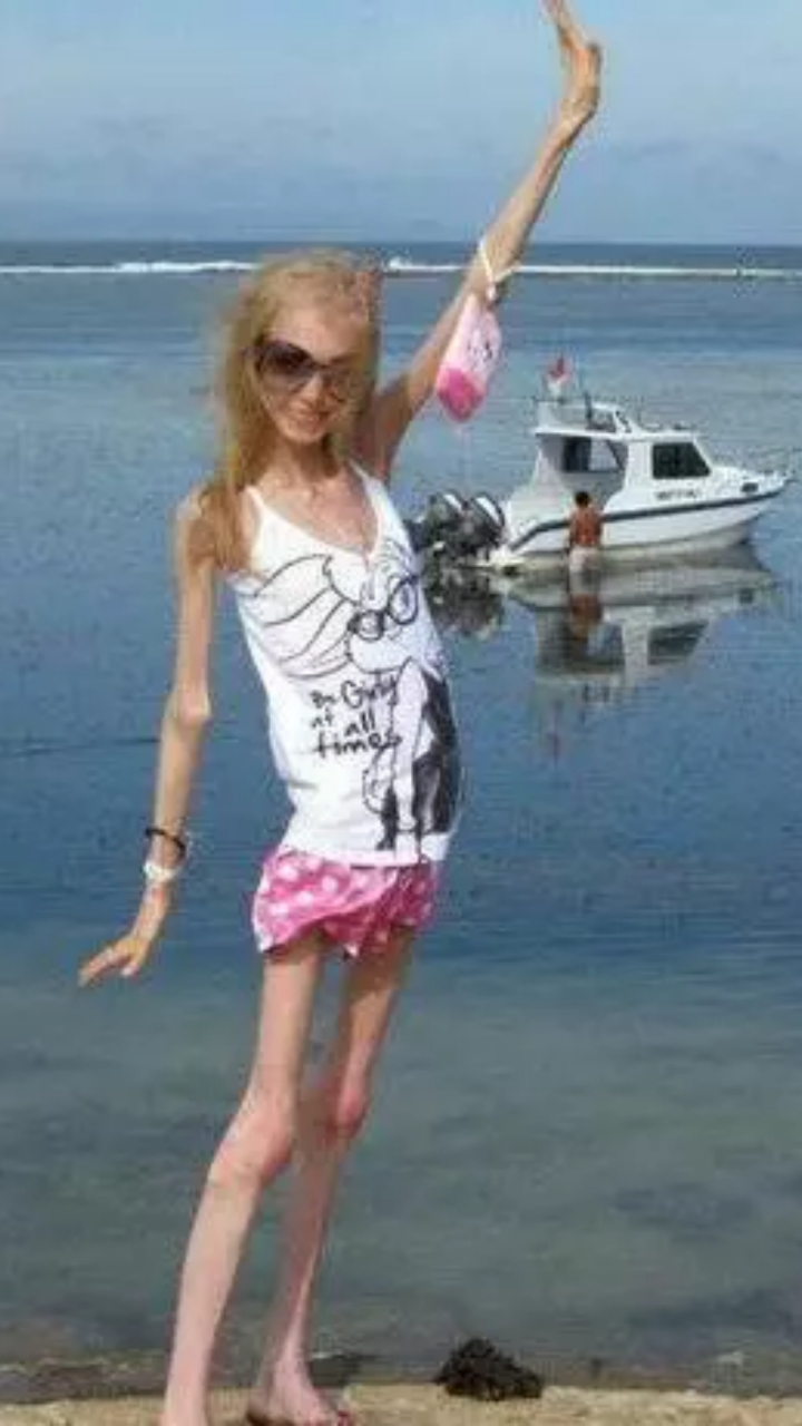 57米,体重只有20公斤,是世界上最瘦的人