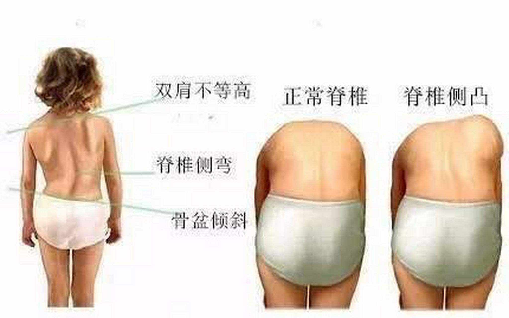 腰线不对称怎么判断是骨盆倾斜或脊柱侧弯?