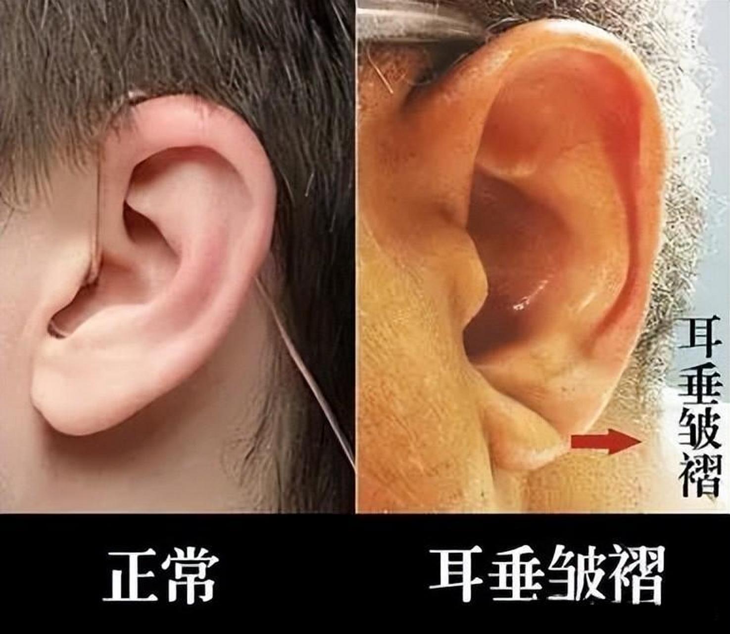 当耳垂出现"冠心沟"时一定要引起注意!