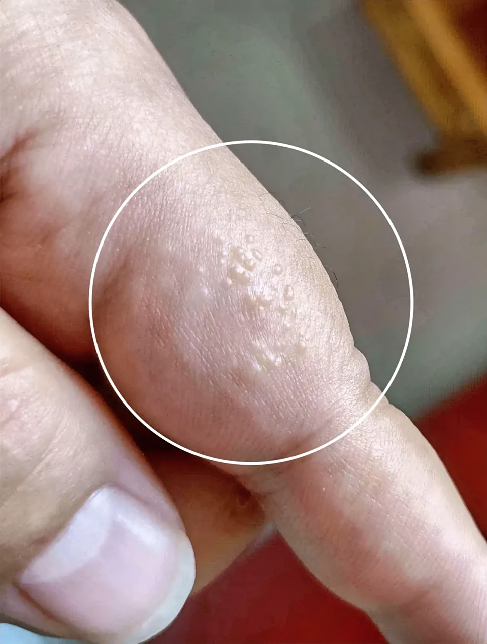 一到夏天,手上就长这种透明小水泡,挤破会越长越多,又痛又痒.