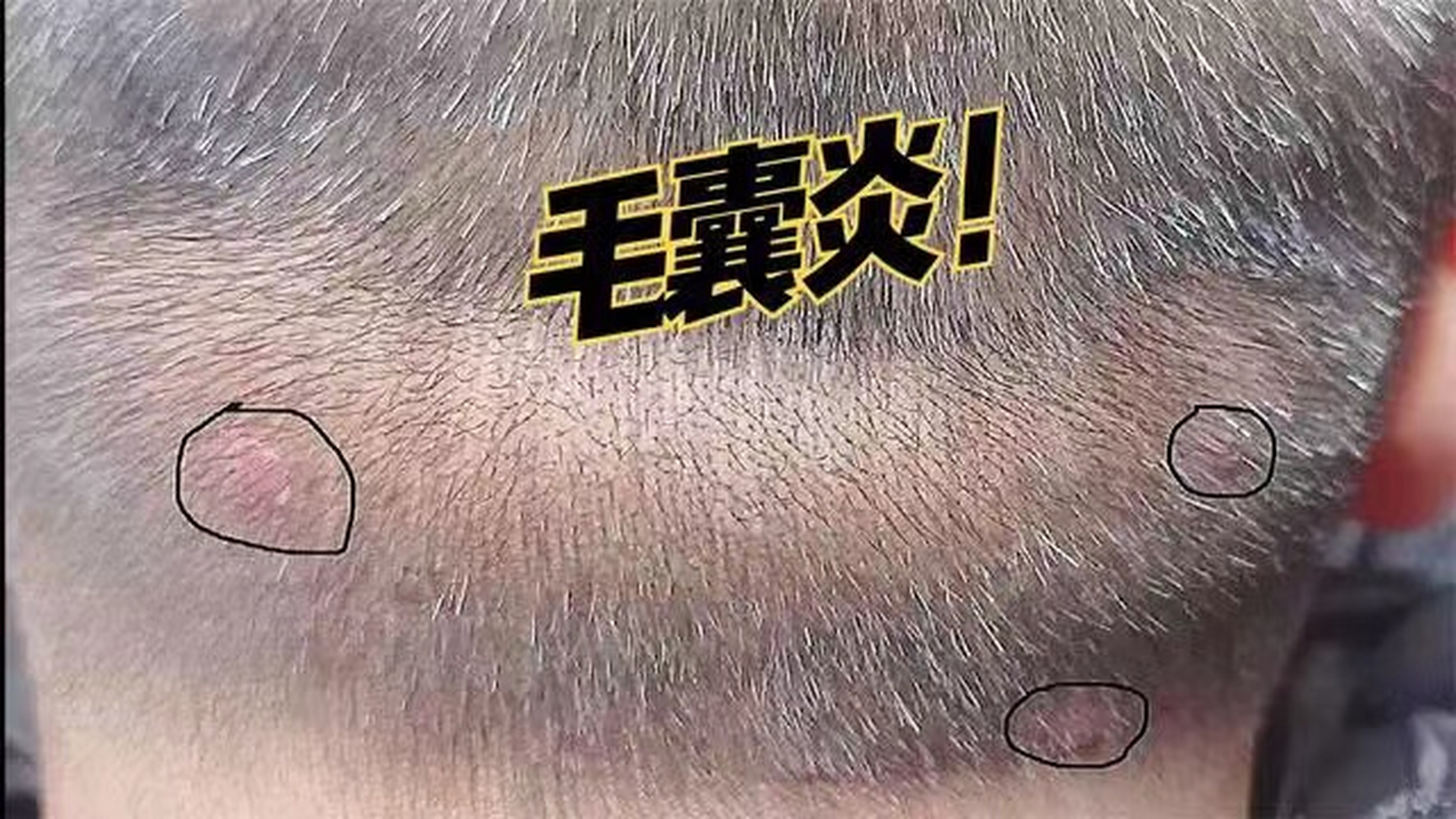 后脑勺的毛囊炎多由葡萄球菌等感染引起,同时存在高温,多汗等诱发