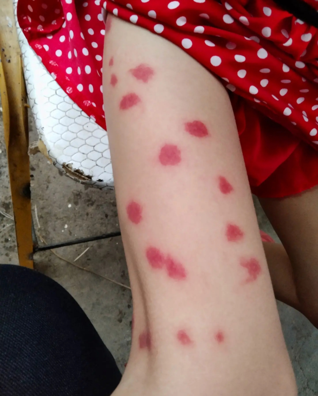 你们说这是什么虫子咬的,放学回来说妈妈我腿上好痒啊,有蚊子咬到我了