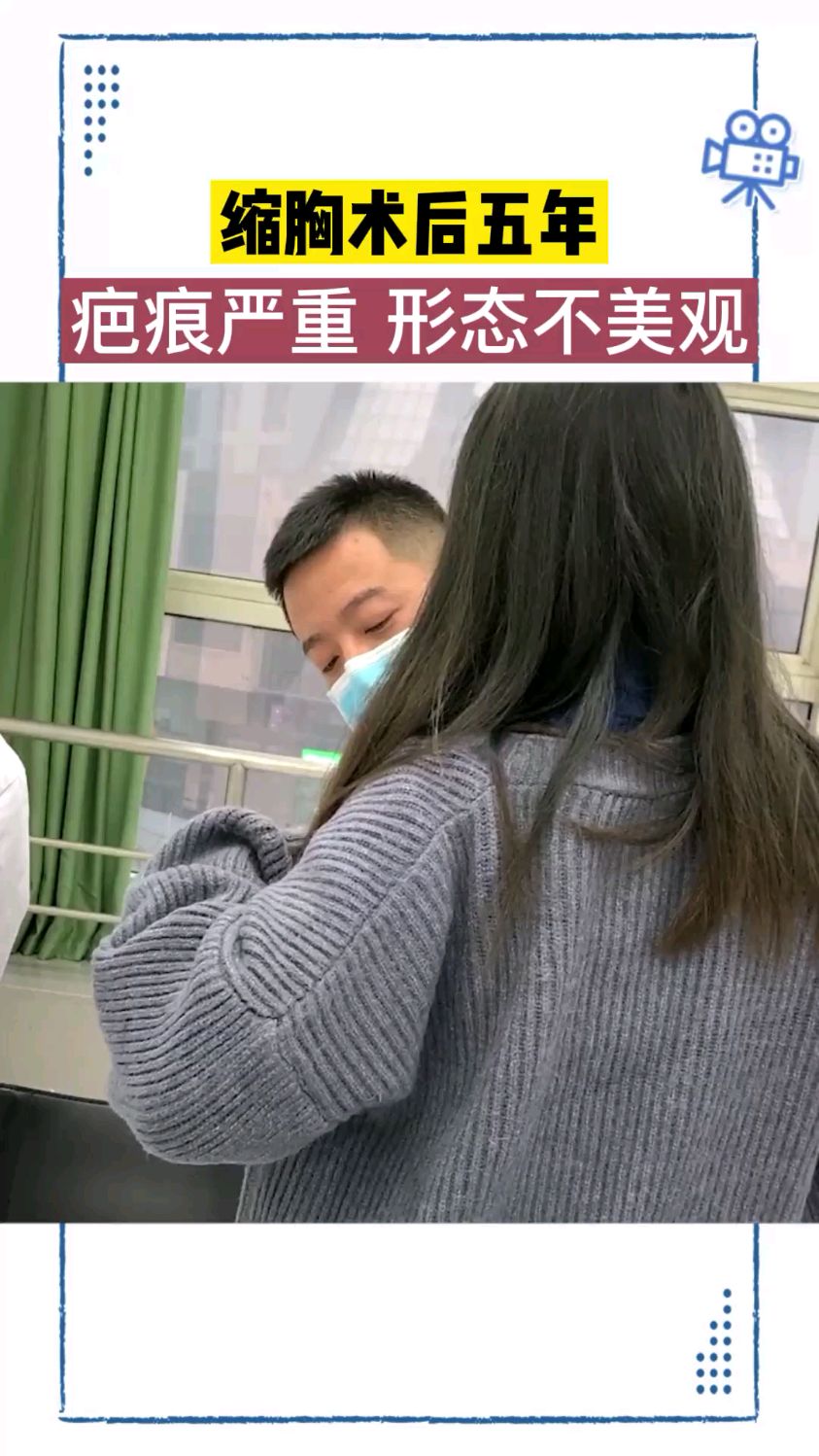 缩胸术后五年因疤痕太大,来面诊做修复