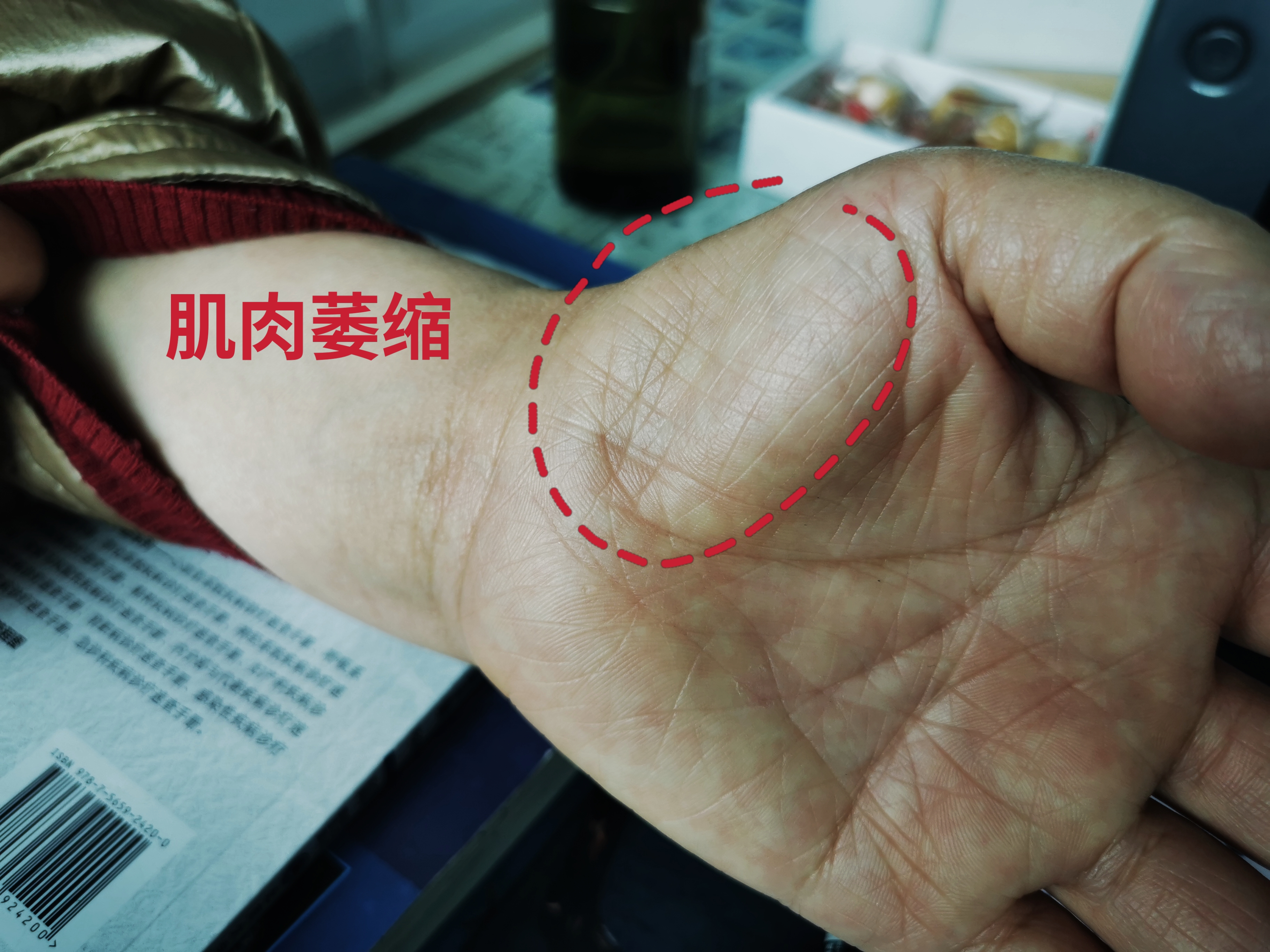 查体的时候,我们能很清楚的看到老人的双侧手掌大鱼际的肌肉萎缩芎 