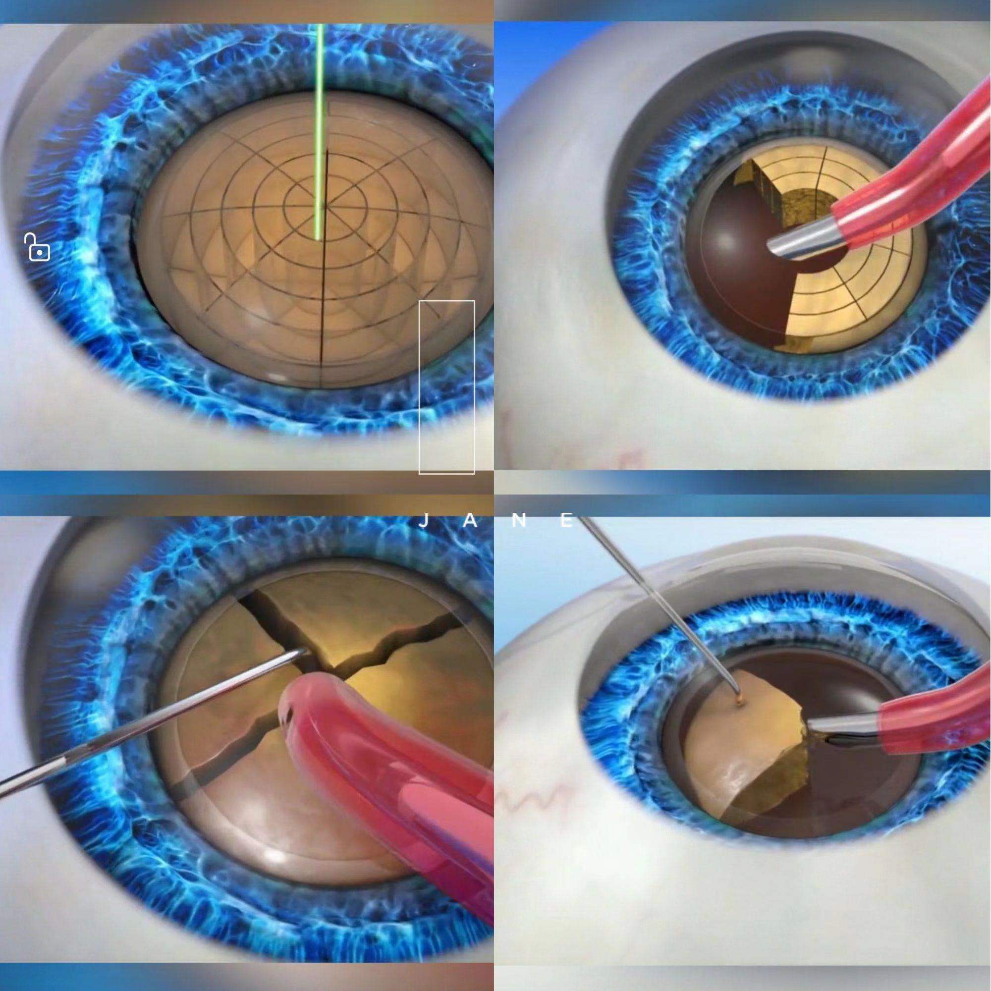 飞秒激光白内障手术