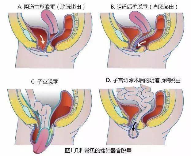 宝妈产后盆底肌松弛