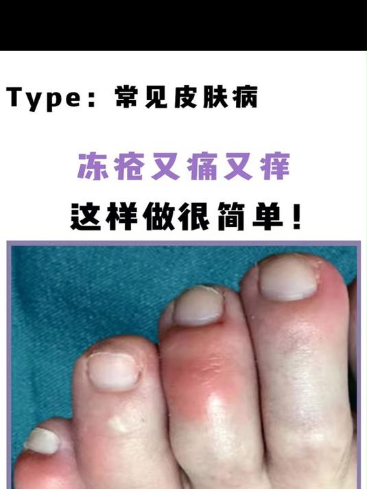 脚长冻疮了怎么办