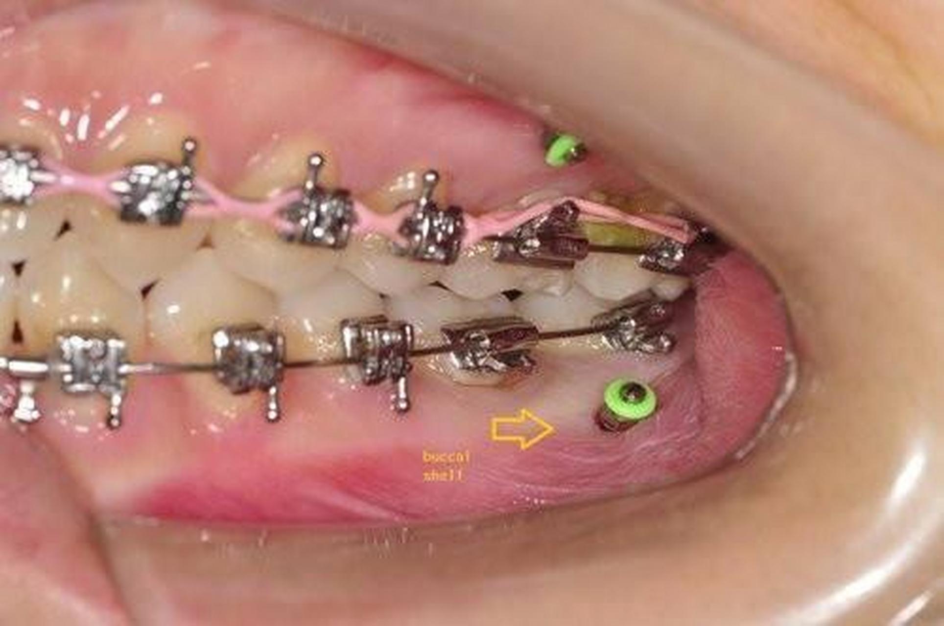 在矫正过程中,想要达到最佳治疗效果,必须精确控制牙齿移动.