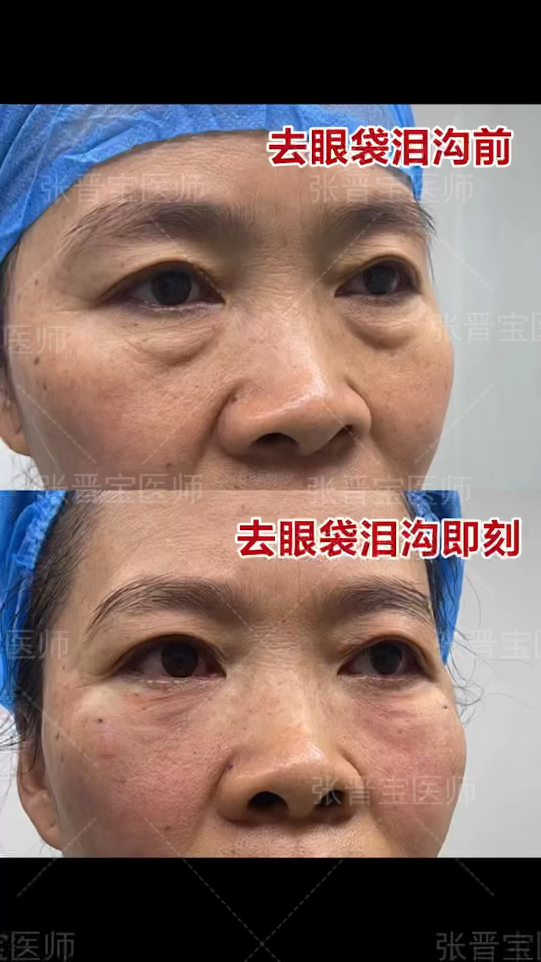 原相机展示微创去眼袋 泪沟填充即刻效果