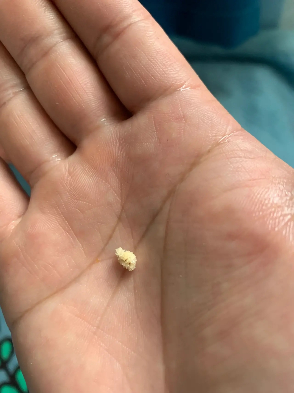 月的肾结石在今天早上终于尿了出来,是一个不规则淡黄色结晶体带毛刺