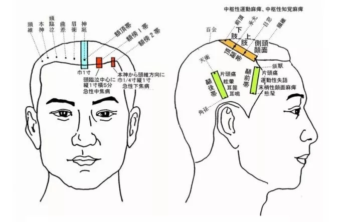 头针进针方法示意图图片