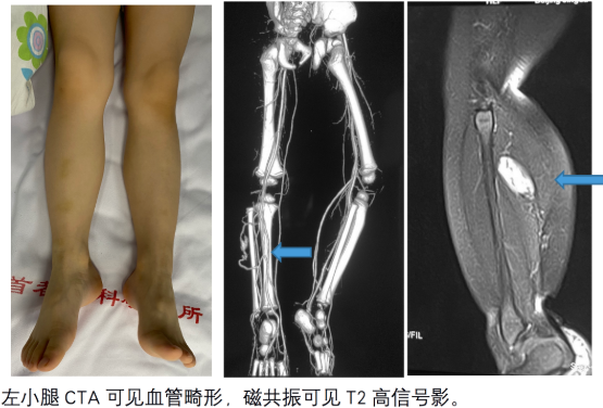 小女孩经常喊小腿疼,确诊左小腿动静脉瘘,介入治疗病例!